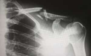 Broken collar bone xray image